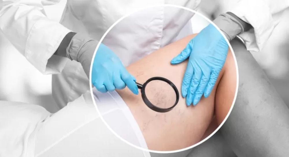 Damar Lazer Tedavisi Nedir? Hangi Durumlarda Uygulanır?