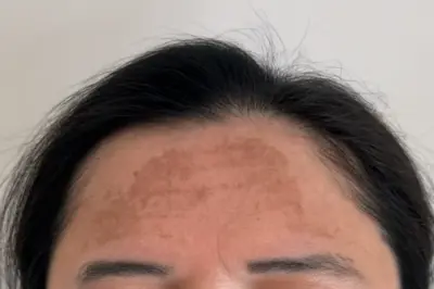 Cilt lekesi Tedavisi Fiyatı nasıl belirlenir? Samsun Cilt lekelerini nasıl tedavi ederiz?