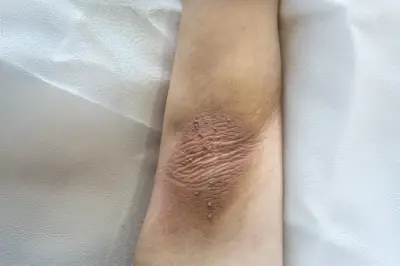 Koltuk Altı Kararması ve Tedavisinde Sık Sorulan Sorular