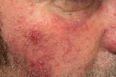 Rozase (Gül Hastalığı) Nedir?