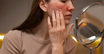 Rozase (Gül Hastalığı) Tamamen Geçer mi? Belirtileri ve Tedavi Yöntemleri