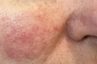 Rozasea Tedavisinde Lazer Uygulamaları: Etki Süresi ve Kalıcılık Hakkında Bilmeniz Gerekenler