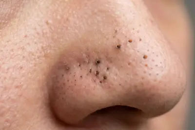 Siyah Nokta ve Komedon Nedir?