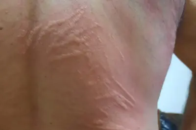 Ürtiker (Kurdeşen) Nedir? Kronik Ürtiker Neden Olur ve Nasıl Tedavi Edilir?