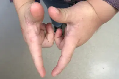 Uyuz ile Karışabilecek Hastalıklar Nelerdir?