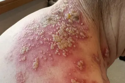 Zona Hastalığı Bulaşır mı? Zona Hastalığı Hakkında Merak Edilenler