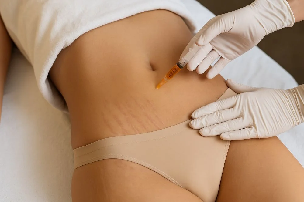 Stria (Çatlak Tedavisi)