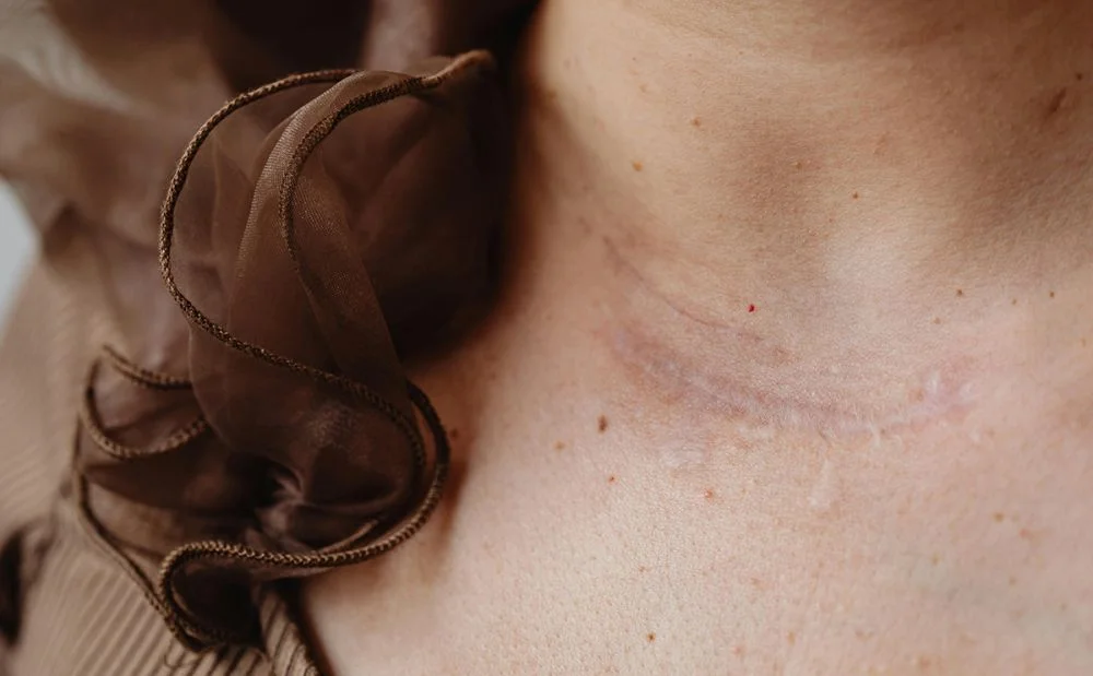 Yara-Yanık-Ameliyat İzi Tedavisi